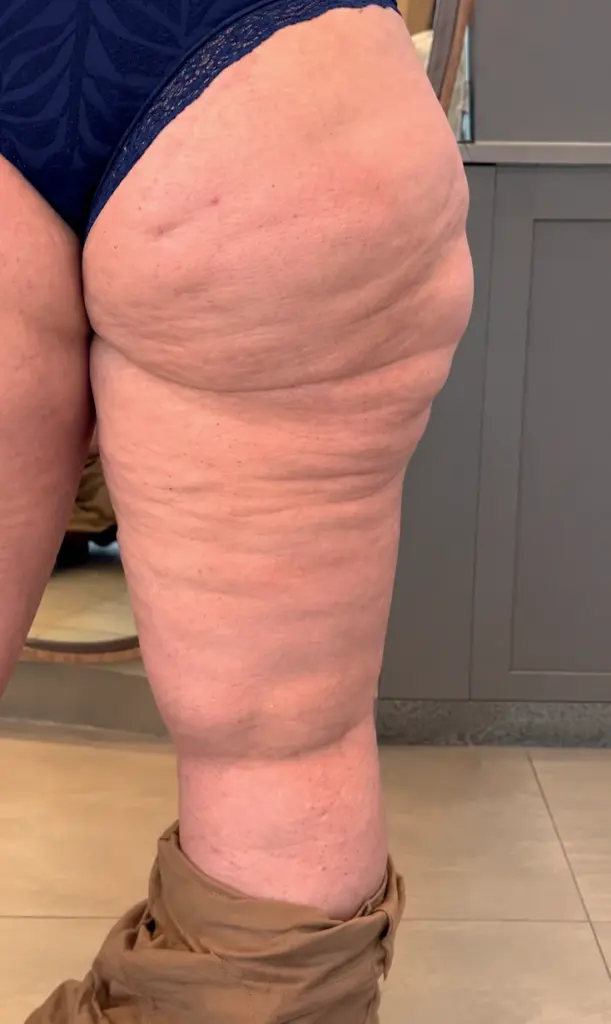 Lipedema — caso 1 — antes do tratamento de lipedema