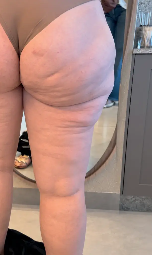 Lipedema — caso 1 — depois do tratamento de lipedema